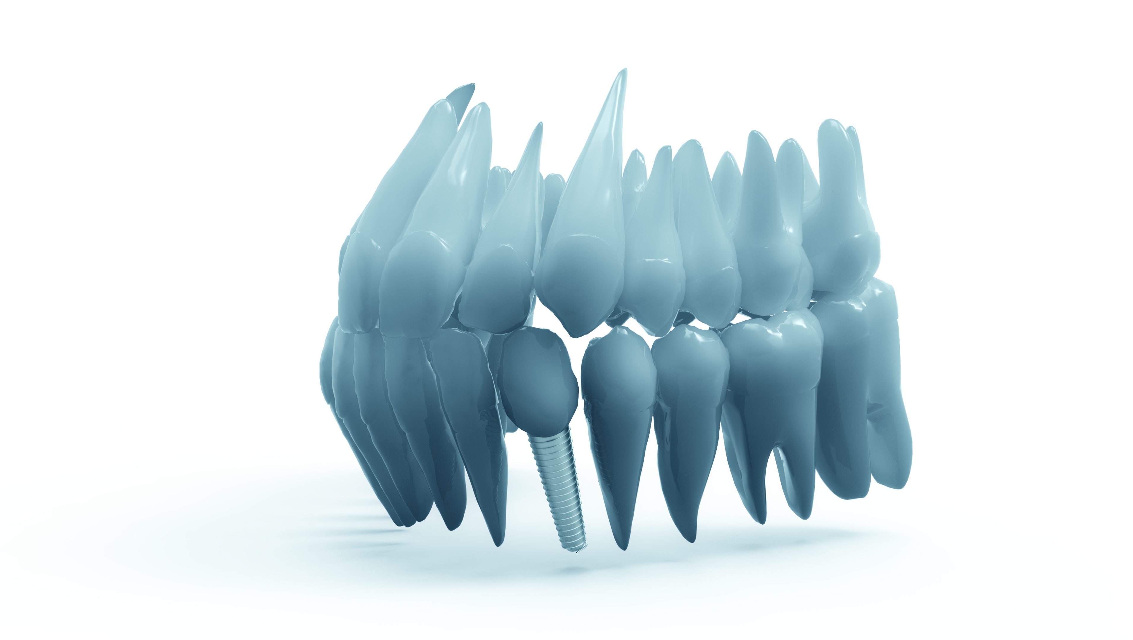 Зд зуб. Имплант челюсти 3д принтер. Зуб 3d модель. Модель имплантов зубов 3д.